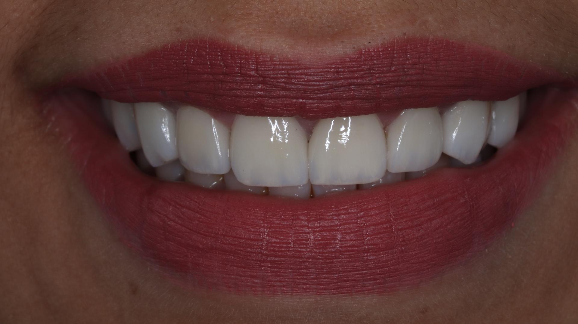 Resultado Keila — Sonrisa frontal